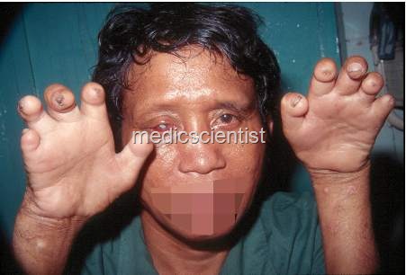 [Leprosy sd[2].jpg]