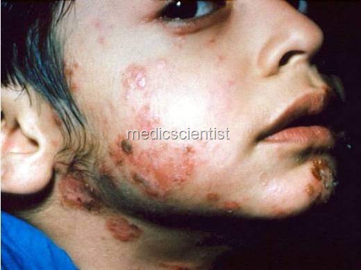 [TUBERCULOID LEPROSY d[2].jpg]
