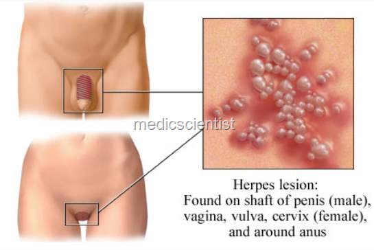 [Herpes simplexrf[2].jpg]