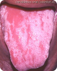 candidiasis-4 candidiasis-4