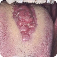 glositis romboidal media glositis romboidal media