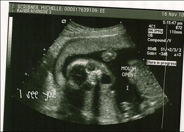 [20 weeks mouth open pic 2010[3].jpg]