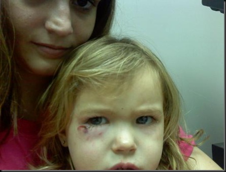 Dog Bite Before Stitches Dog Bite Before Stitches