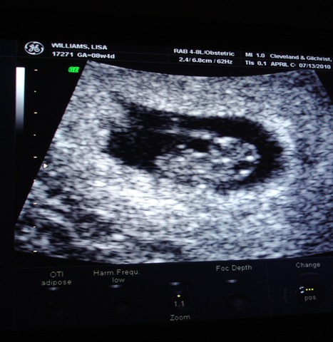 ultrasound 8 weeks. at 8 weeks 3 days.