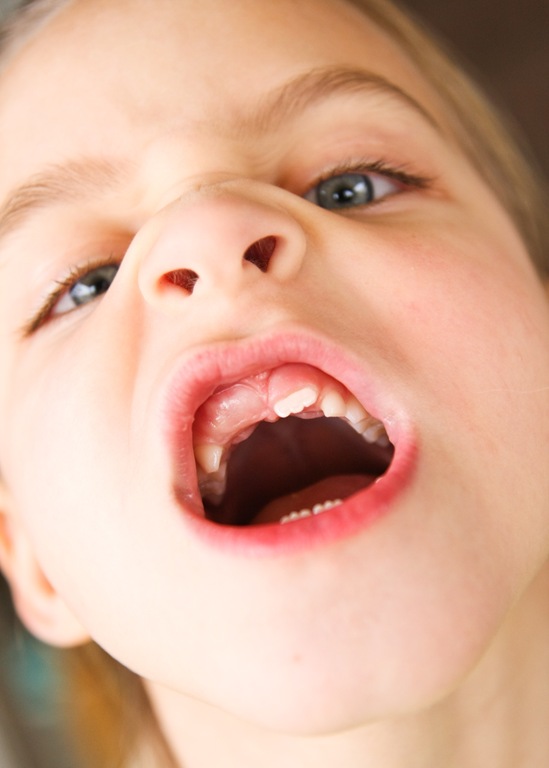 [Morgans front tooth1-9300[6].jpg]