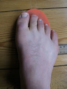 tailor's bunion ski boots