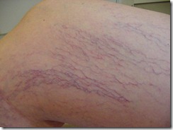 Aranya-Vascular1 Aranya-Vascular1