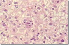 citomegalovirus en higado citomegalovirus en higado