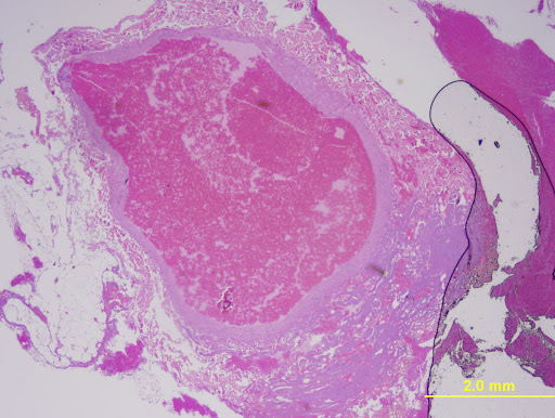 thoracic