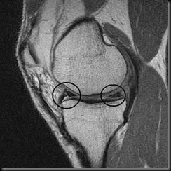 Knee0003