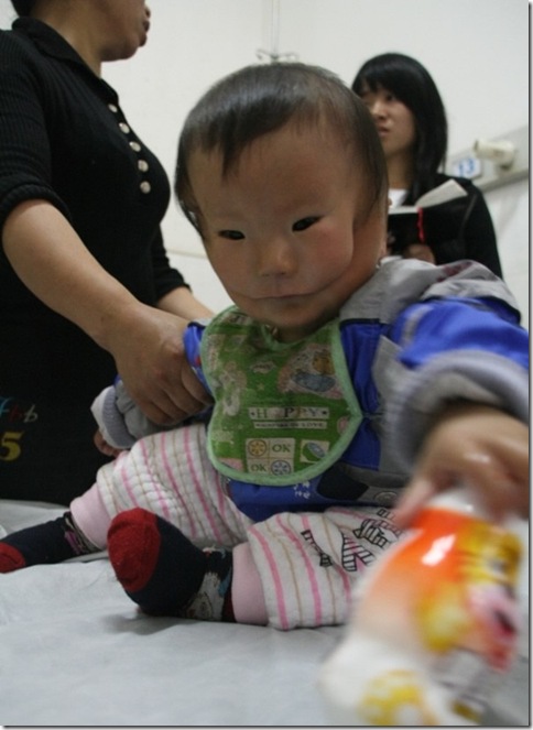 Transverse facial cleft  Boy Photo 2