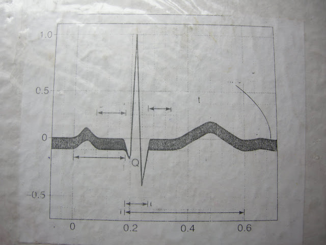 ECG