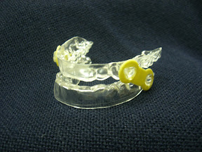 Sleep Apnea Appliance - Preferred Dental Lab