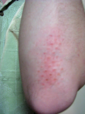 Scraped elbow