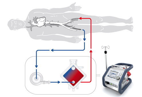 3_2_0_ecmo_01.jpg
