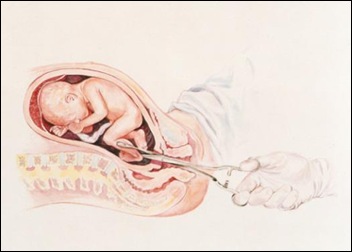 aborto