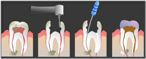 Root_Canal_Illustration