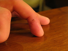Day 12.  The dead skin is starting to peel away here.  I'm not sure why the fingerprints are faded there in the middle, but it's not a digital artifact... that's the way it looks.