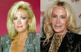 joan van ark antes y despues de la cirugia plastica
