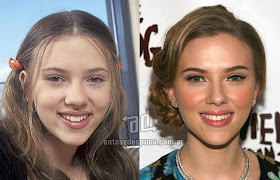 scarlett johansson antes y despues de la cirugia plastica