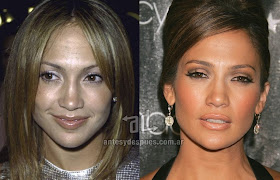 jennifer lopez antes y despues de la cirugia plastica