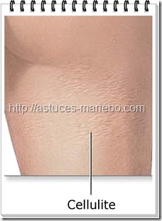 cellulite
