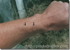 traiter_tendinite_produits_naturels