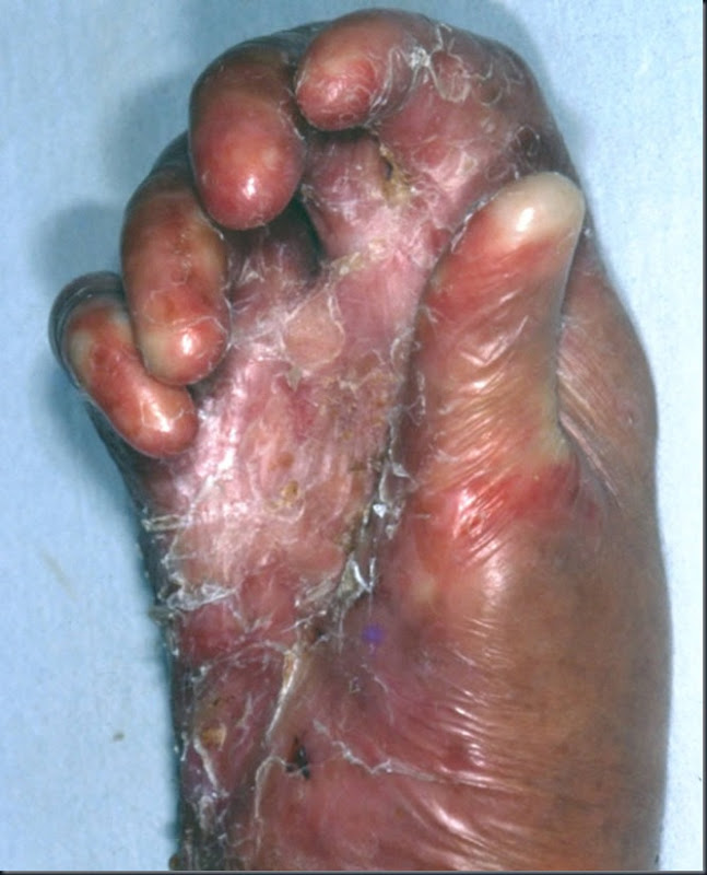 epiderm_bolhosa_11 epiderm_bolhosa_11