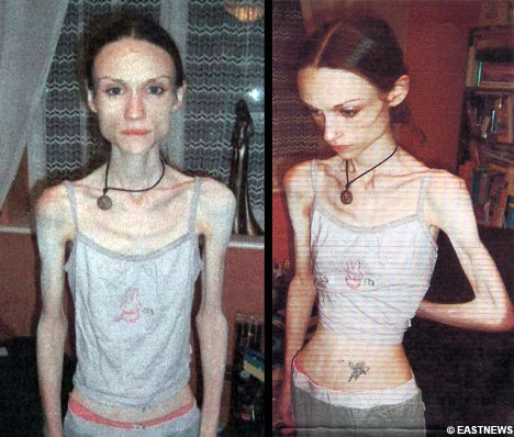 [anorexia1mc3[5].jpg]