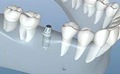 [dental implan type[3].jpg]