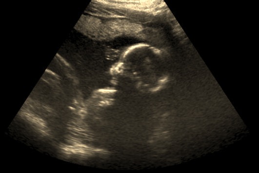 [ultrasound-baby-dunn[8].jpg]