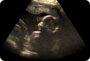 ultrasound-baby-dunn