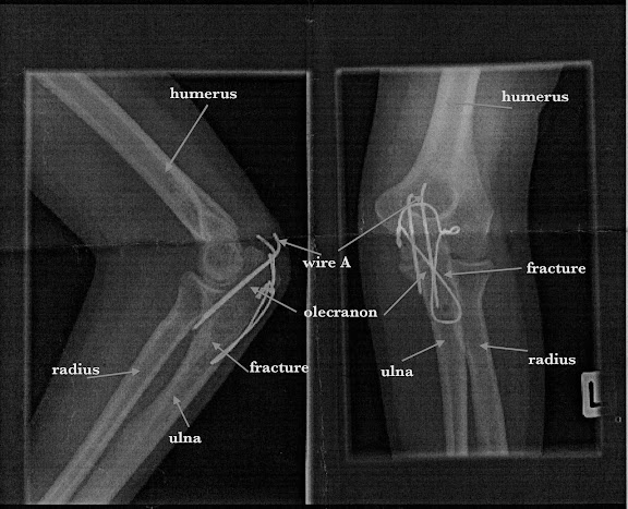 X-ray with wire in