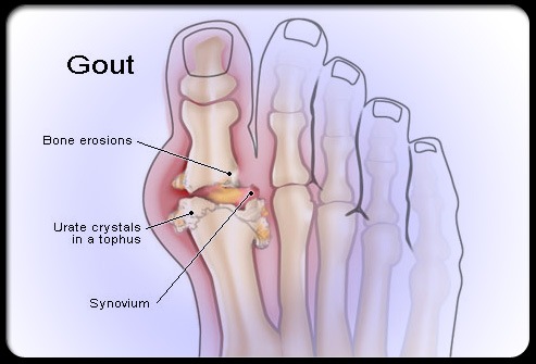 [gout_illustration_s1[3].jpg]