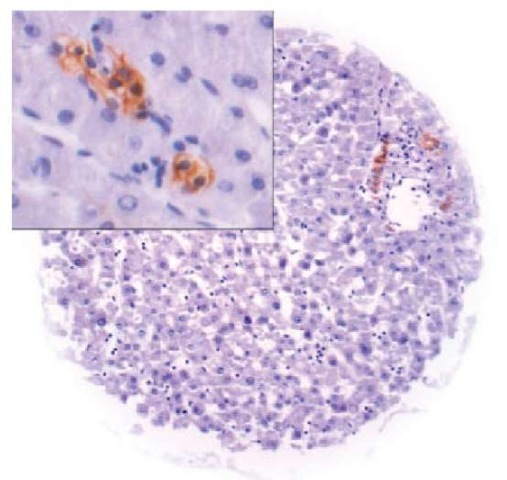 EpCam expression in a tissue spot from normal liver. Inset: 1000x magnification. EpCam expression if confined to small areas of bile ducts. A similar staining intensity, however, can be seen as well in cancer cells. This emphasizes the importance of in situ analyses for normal tissue evaluation. The use of disaggregated tissue for such an expression comparison (like Northern or Western blots) would suggest a negligible low expression level in normal liver 