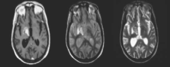 MRI depiction 