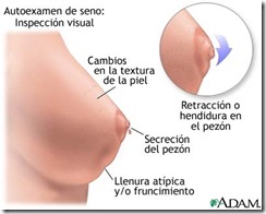 CANCER DE MAMA