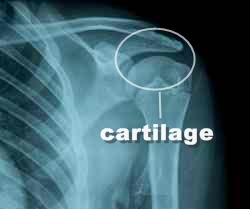 Cartilage