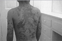 Stevens-Johns Syndrome - Phillips Webster Steven-Johns Syndrome