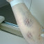 My bruised up arm from all the needles over the last week.
