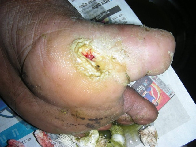 [diabetes foot[5].jpg]