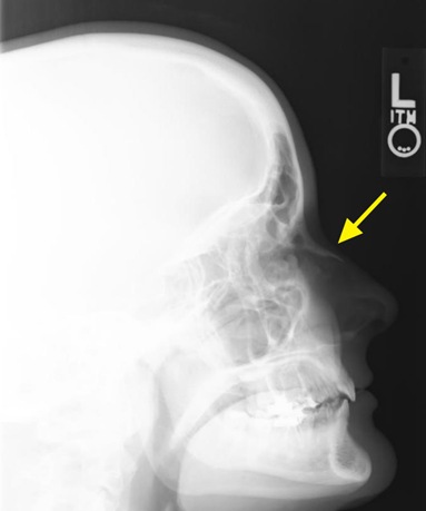 [Broken Nose X-Ray 1[4].jpg]