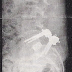 foto mojí rozvrtaný páteře 001a.jpg