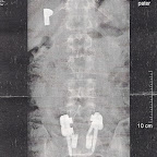 foto mojí rozvrtaný páteře-b.jpg