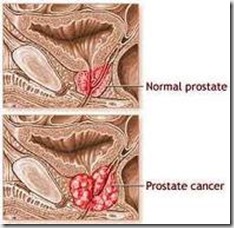 prostateCacer