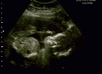 Ultrasound at 19 weeks