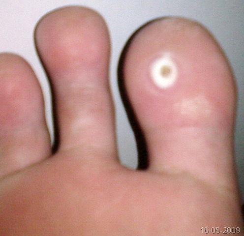 [2009-05-16 - toeCorn[10].jpg]