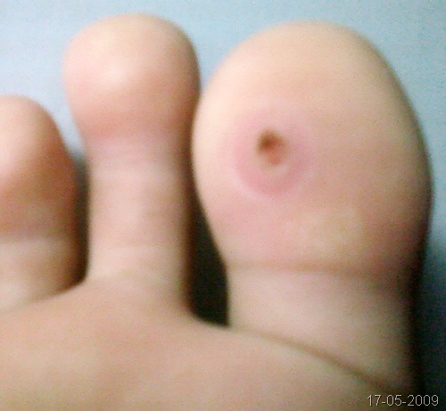 [2009-05-17 - toeCorn[6].jpg]