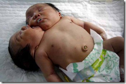 Nace en China bebe con dos cabezas