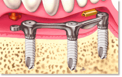 [dental_implant[5].gif]